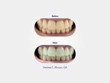 Load image into Gallery viewer, Prefilled Whitening Trays 7 pack
